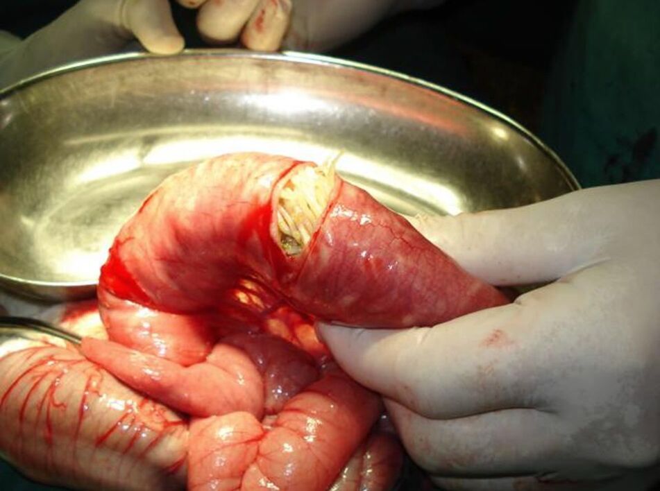 Lombrices intestinales en el intestino humano.