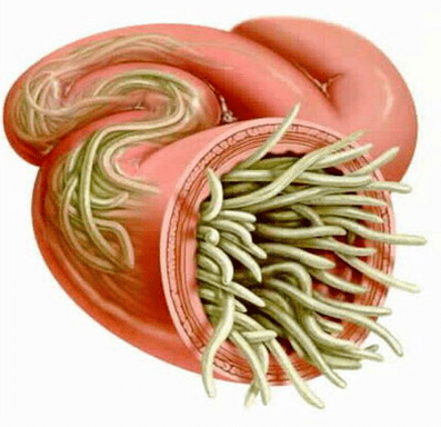 lombriz intestinal en el intestino humano